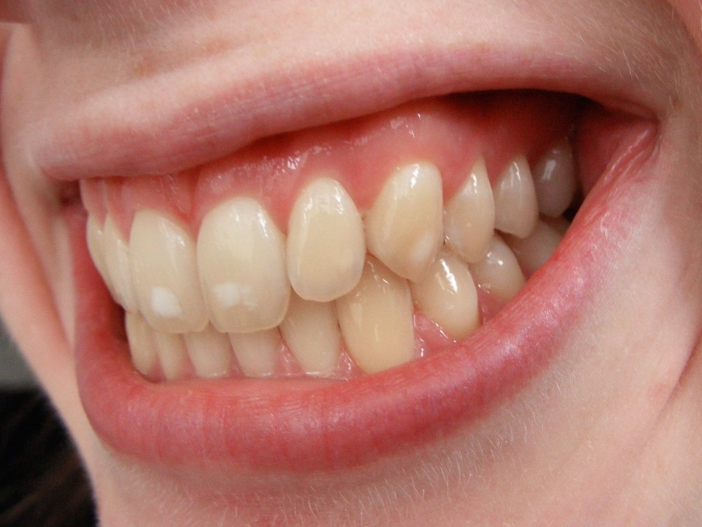 Mottled enamel, the first sign of too much fluoride. It appears years after the exposure began.